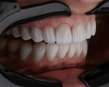 Best Cosmetic Option for Your Smile
