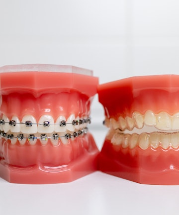 Invisalign clear aligners fixed braces orthodontics Coventry