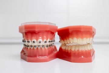 Invisalign clear aligners fixed braces orthodontics Coventry