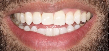 Invisalign After Picture