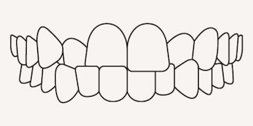 Crossbite - illustration - Longfellow Road Dental