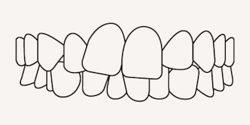 Crowded teeth - illustration - Longfellow Road Dental