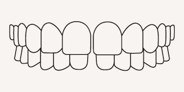 Gap teeth - illustration - Longfellow Road Dental