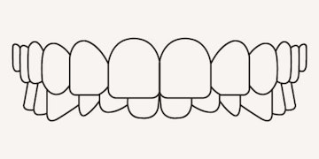 Overbite - illustration - Longfellow Road Dental