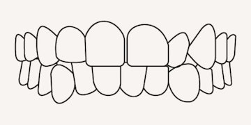 Straighter teeth - illustration - Longfellow Road Dental